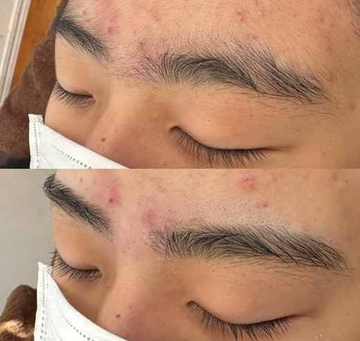 特殊部位眉毛脱毛
