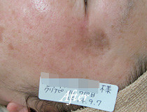 施術2
