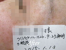アフター